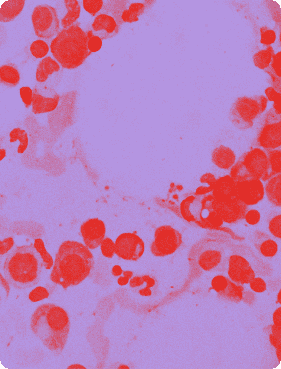 Multiple Myeloma: